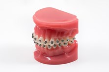 De behandeling -Orthodontie